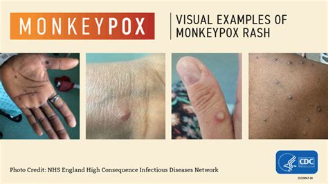 sore throat, nasal congestion, or cough). . Monkeypox rash itchy or painful